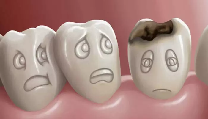 پیشگیری از پوسیدگی دندان